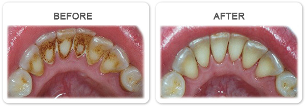 Proper individual ultrasonic dental hygiene