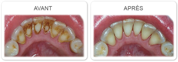 Hygiène individuelle ultrasonore de la cavité buccale
